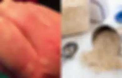 Obat Biduran Tradisional yang Bisa Dicoba Sebelum Pergi ke Dokter