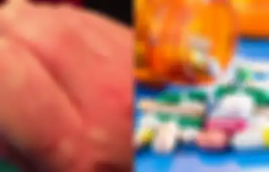 Obat Biduran untuk Membasmi Gatal Karena Perubahan Cuaca Musim Panas