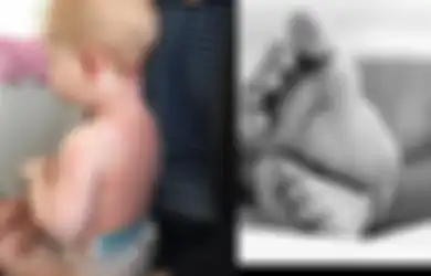 Alami Ruam di Sekujur Tubuhnya, Bayi 8 Bulan Ini Meninggal Karena Penyakit Kawasaki, Dokter Duga Juga Terkait Virus Corona