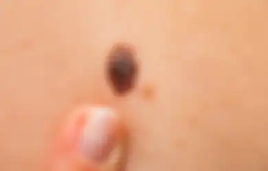 Waspada! 5 Hal Ini Menjadi Pertanda Jika Tahi Lalat yang Ada di Tubuh adalah Kanker
