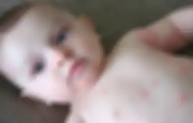 Ini Obat Biduran untuk Bayi: Tempatkan di Ruangan yang Dingin