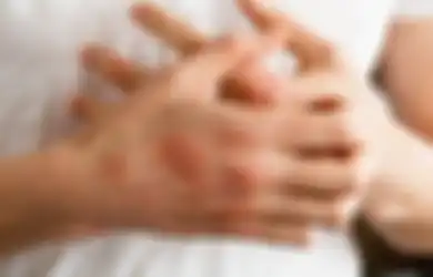 Gara-Gara Ciuman, Cowok Ini Gugat Rp 2 Miliar ke Ceweknya yang Nularin Herpes