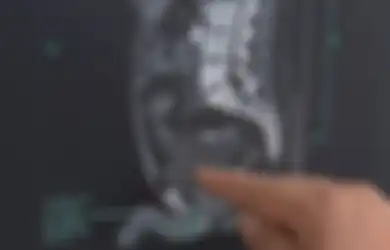 Gara-gara Kebanyakan Minum Minuman Ini, Seorang Pria Kandung Kemihnya 'Meledak', Dokter Ungkap Penyebabnya Seringkali Kita Lakukan