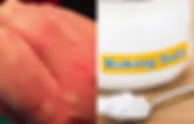 10 Obat Biduran Alami Ampuh Redakan Gatal dan Ruam, Termasuk Soda Kue