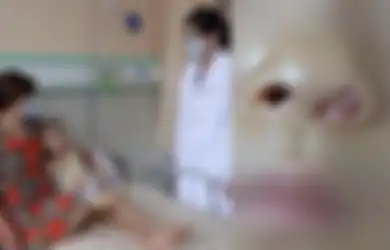 Gara-gara Tersandung dan Jatuh, Bocah ini Ngeluh Susah Bernapaas, Setelah Diperiksa Dokter Temukan ini di Hidungnya