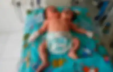 Sempat Akan Diaborsi Ketika Masih dalam Kandungan, Ibunya Syok Saat Terlahir Bayinya Memiliki Dua Kepala, Sebelumnya Dokter Ungkap Hal Ini