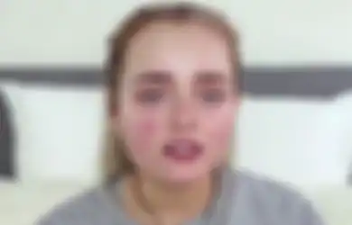 Kulit Bakal Gampang Jerawatan Kalau Lakukan 7 Kesalahan Makeup Ini!