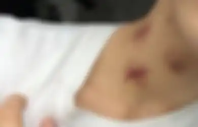 Berhenti Berikan 'Cupang' pada Pasangan Anda, Remaja Laki-laki Usia 17 Tahun Ini Kejang-kejang Lalu Meninggal Karena Dicupang Pacarnya