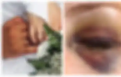 Bikin Orang Penasaran karena Matanya Bengkak setelah Malam Pernikahan, Wanita Ini Mengungkap Insiden Konyol yang Menimpanya dan Suami