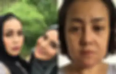 Jadi Korban Malpraktik Klinik Kecantikan, Wajah Rency Milano Turun ke Bawah, Bibir dan Dagu Kakak Elma Theana Keluarkan Nanah dan Mengeras