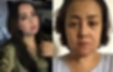 Niat Hati Ingin Percantik Diri, Artis Ini Malah Jadi Korban Malpraktik Klinik Kecantikan Hingga Alami Kerusakan di Wajahnya, Begini Kondisinya yang Bikin Bergidik Ngeri