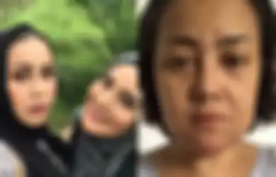 Niat Hati Ingin Tampil Menarik, Kakak Elma Theana Diduga Jadi Korban Malpraktik Klinik Kecantikan, Dagu dan Bibirnya Keluarkan Cairan Pekat