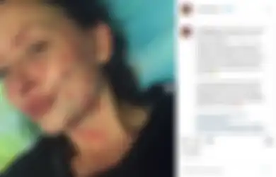 Berawal dari Ciuman Malam Tahun Baru, Kulit Cewek Ini Kena Psoriasis yang Gak Bisa Disembuhkan
