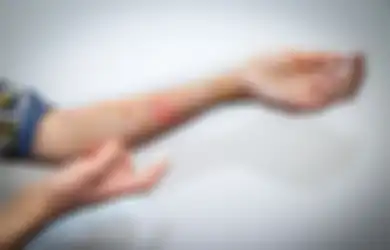 Nyesel Engga Tahu dari Dulu, Begini Cara Mendapatkan Penanganan Luka Bakar Gratis dengan BPJS