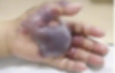 Begini Cara Mudah Keluarkan Duri dari Kulit Bagi yang Masih Kesulitan