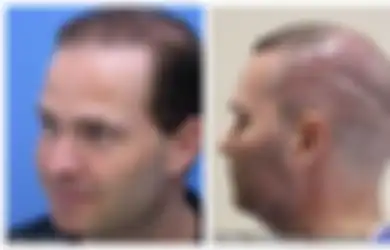 Pernikahan Pria Ini Hancur karena Terobsesi dengan Transplantasi Rambut, Lakukan 7 Kali Operasi dan Miliki Banyak Hutang, Ini Awal Mula Ketakutannya