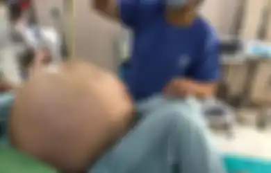 Membuat Dokter 'Terkejut Setengah Mati', Wanita Ini Miliki Tumor Ovarium Raksasa Terbesar di Dunia, Begini Kisah Diangkatnya Tumor Seberat 49Kg Itu