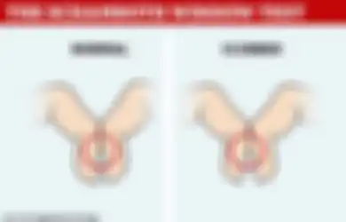 Lakukan Tes Sederhana Ini Untuk Buktikan Apakah Anda Punya Kanker Paru: Cukup Cari Celah di Antara Dua Jari Anda, Mudah!