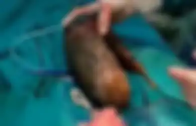 Mengeluh Sakit, Setelah Dioperasi Dokter Temukan Gumpalan Mengerikan Seberat 7 Kg di Perut Gadis Ini, Terungkap Kebiasaan Aneh yang Dilakukannya Sejak Kecil