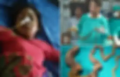Ada Gumpalan Rambut Seberat 7 Kg di Dalam Perut Remaja 17 Tahun Ini, Ternyata Dia Idap Kondisi Langka yang Membuatnya Makan Rambutnya Sendiri