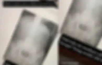 Viral X-ray Pasien Wanita Usia 55 Tahun Dipenuhi Susuk: Benarkah Susuk Mampu Ubah Pemakainya Jadi Cantik?