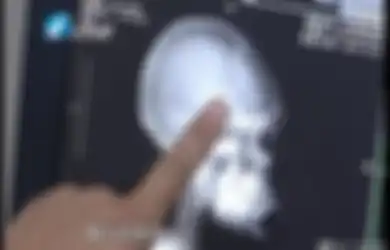 Lakukan CT Scan pada Kepalanya Setelah Kecelakaan, Wanita Ini Malah Temukan 2 Jarum di Dekat Otaknya