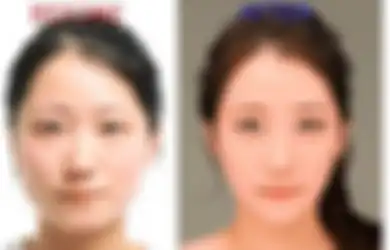 Benarkah Semakin Cantik? Ini 6 Operasi Plastik yang Paling Terkenal dan Sering Dilakukan di Korea Selatan