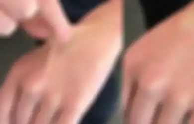 Cubit Tangan Bisa Tunjukkan Tubuh Dehidrasi atau Enggak! Kok Bisa?