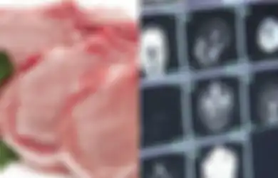 Lobotomi, Prosedur Penyembuhan Penyakit Jiwa yang Nggak Manusiawi Bin Horor