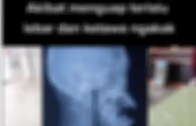 Viral Mulut Nggak Bisa Ditutup Akibat Menguap Terlalu Lebar, Ini Penjelasan Dokter