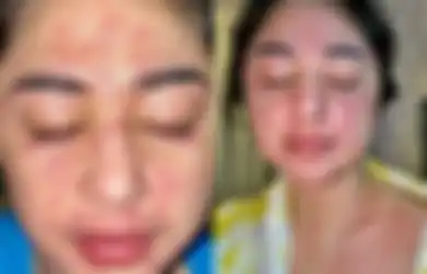 Seluruh Tubuh Dewi Perssik Dipenuhi Ruam dan Bercak Merah Akibat Infeksi Covid-19, Begini Cara Mengenali Gejalanya