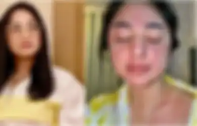 Positif Covid-19, Dewi Perssik Alami Gejala Ruam Kulit Merah di Wajah Hingga Tubuh, Kenali Ciri-Ciri Ruam Kulit yang Jadi Gejala Covid-19