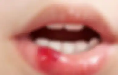 Sariawan Kerap Muncul Usai Tambal Gigi, Dokter Beri Penjelasan Ini hingga Singgung Soal Kondisi Traumatik