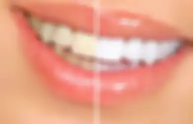Ingin Gigi Putih Alami Secara Instan? Pakai Produk Whitening Strip Ini