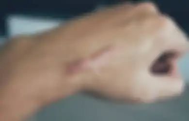 Nggak Pede Punya Bekas Luka, Begini Cara Alami Menghilangkannya, Luka Perasaan Gimana?