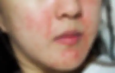 Stop Lakukan 5 Kebiasaan Skincare Ini Buat Kulit Sensitif. Jadi Parah!