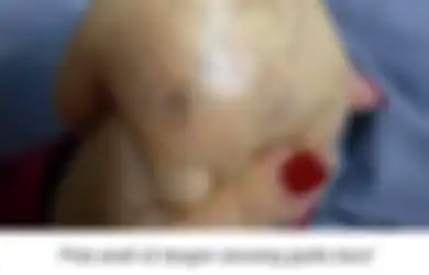 Orangtua Wajib Mulai Waspada! Berawal dari Tanda Aneh di Tangan Anaknya, Ibu Ini Ketakutan hingga Lapor Polisi, Rupanya Tanda Tersebut Dapat Mengancam Hidup Anaknya