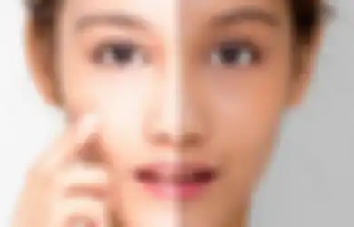Tips Hidup Hempas Kulit Belang, Jangan Khawatir Warnanya Bisa Diratakan Kembali dengan Cara Ini