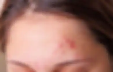 Hindari 4 Kandungan Skincare Ini Saat Berjerawat, Bisa Makin Parah