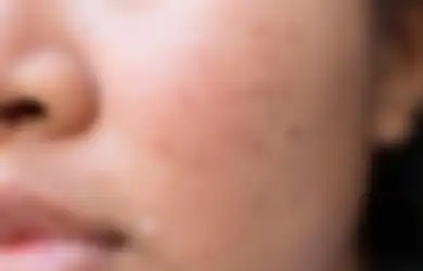5 Cara Menghilangkan Bopeng Akibat Jerawat, Dijamin Bisa Mulus