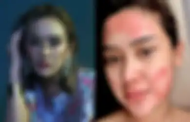 Kerap Suntik Putih dan Vitamin Jadi Penyebab Dirinya Idap Autoimun, Cita Citata Kapok Gunakan Produk Kimia