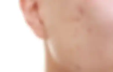 Susah Mulus? 5 Penyebab Ini Bikin Wajah Penuh Noda dan Enggak Flawless