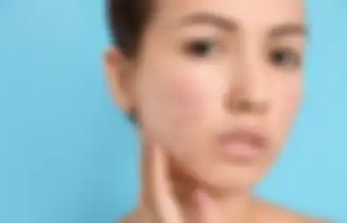 Bukan Masalah Sepele, Jerawat Bisa Memicu Depresi Menurut Penelitian!