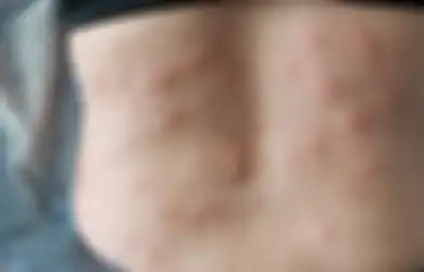 Tiga Bahan Alamiah Ini Bisa Jadi Obat Alami Biduran, Apa Saja?