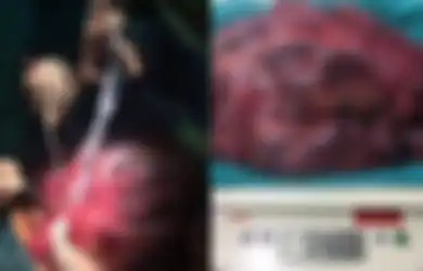 Pria 52 Tahun Ini Menjerit Kesakitan, Dokter Temukan 'Benda' Seberat 5 Kg Dari Perutnya Setelah Operasi, Faktanya Sangat Mencengangkan