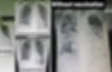 Unggah 4 Foto Rontgen Paru-paru, Dokter Ini Bongkar Kondisi Pasien Covid-19 yang Sudah dan Belum Divaksin, Perbandingannya Mencengangkan