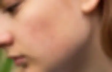 Mulus! Hempaskan Jerawat Bruntusan Pakai 3 Sabun Cuci Muka Murah Ini!