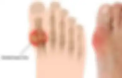 Bisa Dilihat dari Jempol Kaki, Pertanda ini Tunjukkan Jika Kamu Mederita Asam Urat, Cek Sekarang Juga