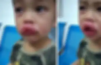 Bikin Syok Berat! Bocil Iseng Comot Makanan di Kulkas, 10 Menit Berlalu Justru Nangis Kejer Saat Bibirnya Mendadak Bengkak Parah, Faktanya Diungkap sang Ayah