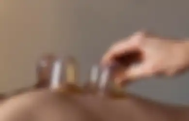 Ketiduran Saat Terapi Bekam, Wanita Ini Kaget Temukan Hal Mengerikan Terjadi pada Kulitnya, Dokter Sampai Harus Lakukan Tindakan Khusus untuk Menolongnya